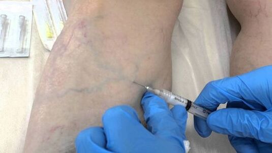 skleroterapia për venat me variçe në këmbë tek gratë