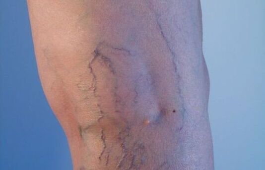 venat me variçe në këmbë tek gratë