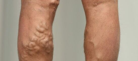 venat me variçe në këmbë